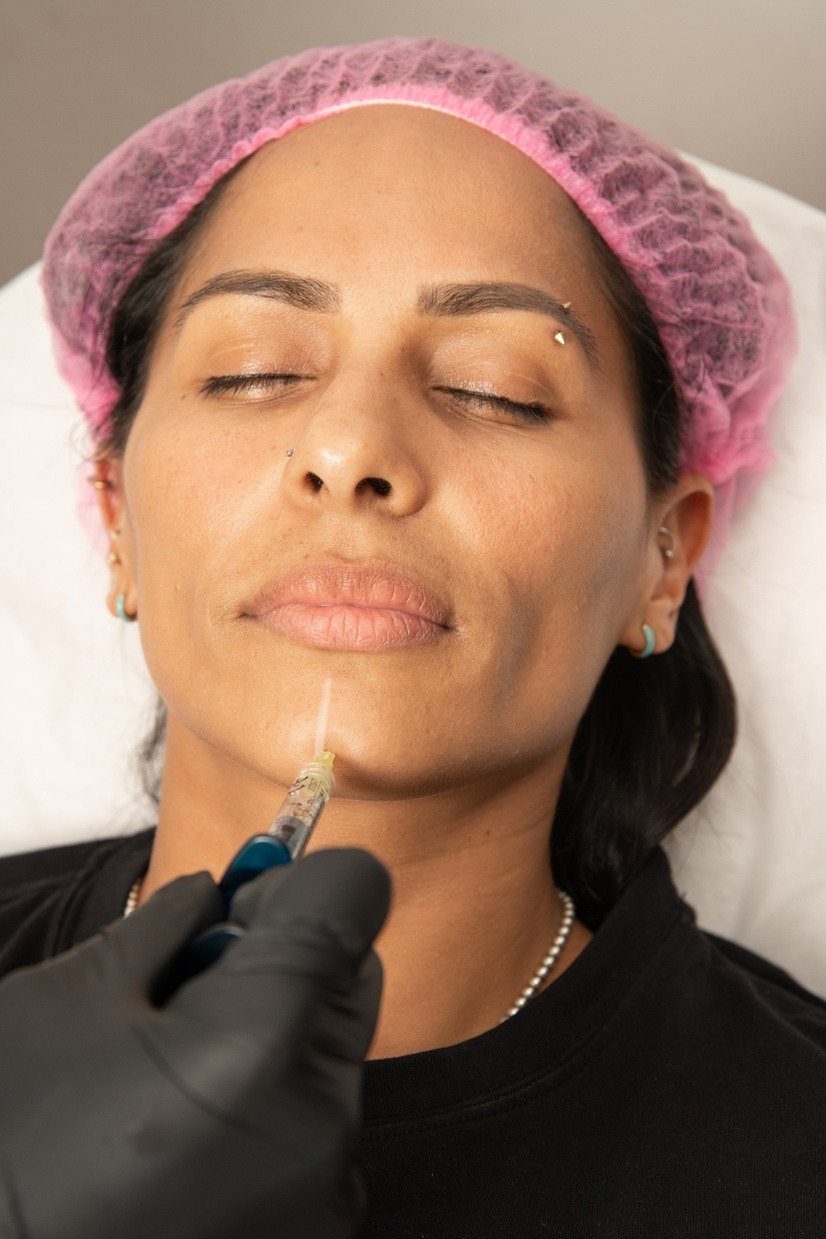 Hyaluronic Acid Fillers